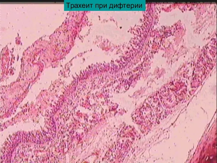 Трахеит при дифтерии