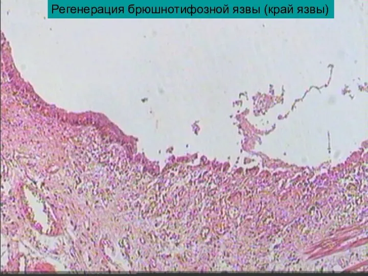 Регенерация брюшнотифозной язвы (край язвы)