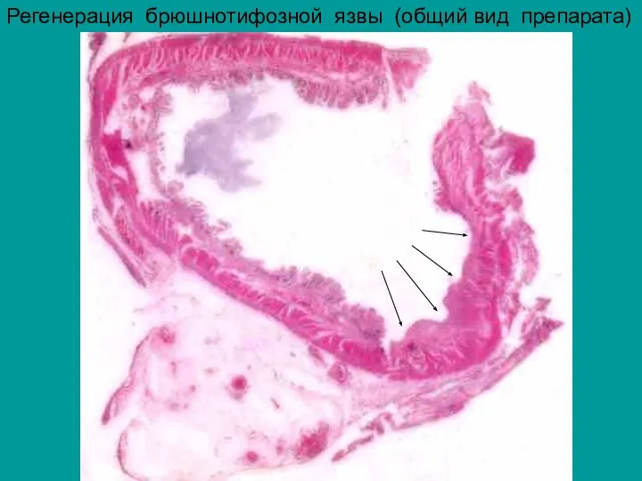 Регенерация брюшнотифозной язвы (общий вид препарата)