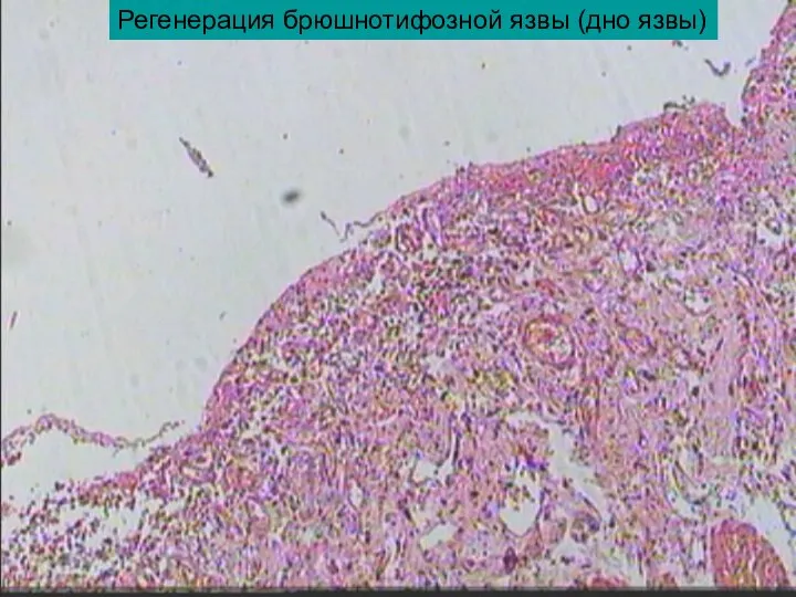 Регенерация брюшнотифозной язвы (дно язвы)