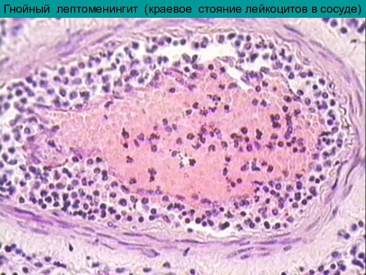 Гнойный лептоменингит (краевое стояние лейкоцитов в сосуде)