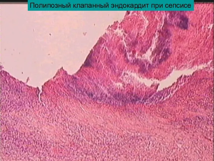 Полипозный клапанный эндокардит при сепсисе