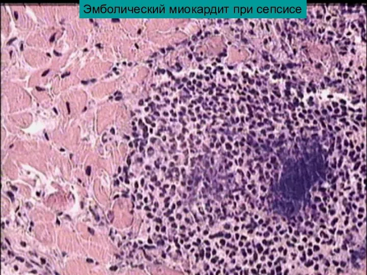 Эмболический миокардит при сепсисе