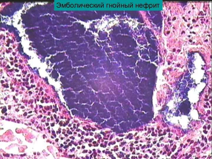 Эмболический гнойный нефрит