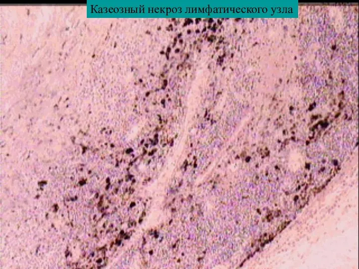 Казеозный некроз лимфатического узла