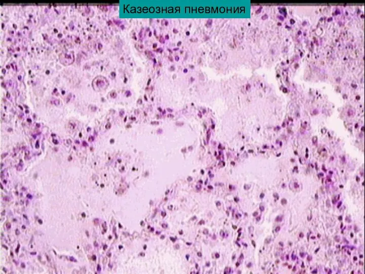 Казеозная пневмония