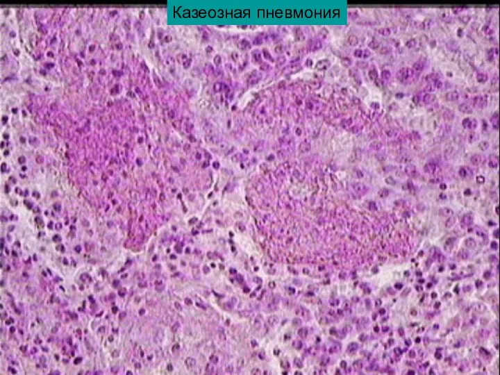 Казеозная пневмония