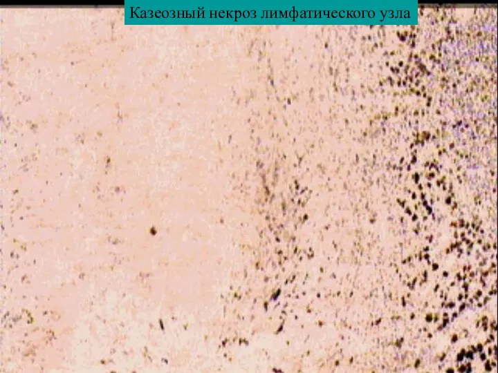 Казеозный некроз лимфатического узла