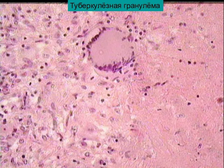 Туберкулёзная гранулёма