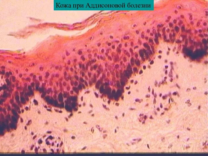 Кожа при Аддисоновой болезни