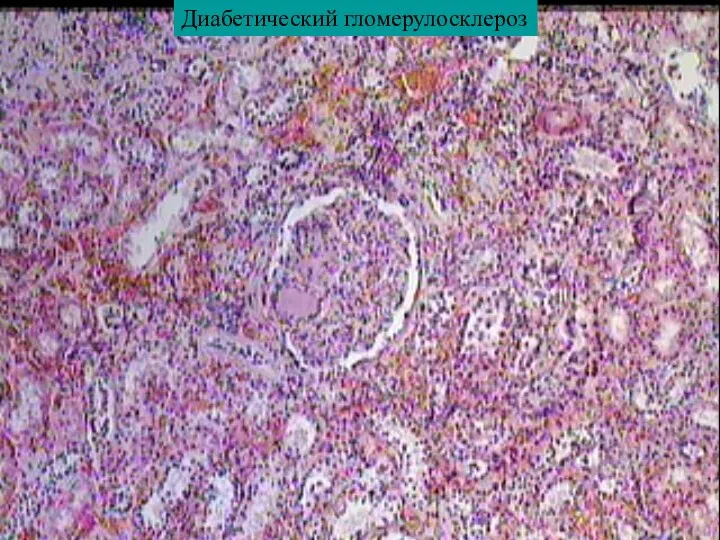 Диабетический гломерулосклероз
