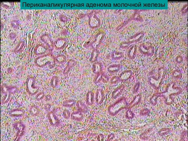 Периканаликулярная аденома молочной железы