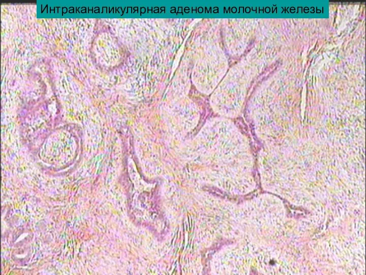 Интраканаликулярная аденома молочной железы