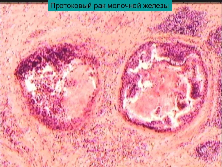 Протоковый рак молочной железы