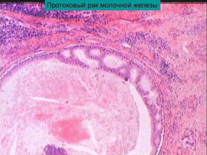 Протоковый рак молочной железы