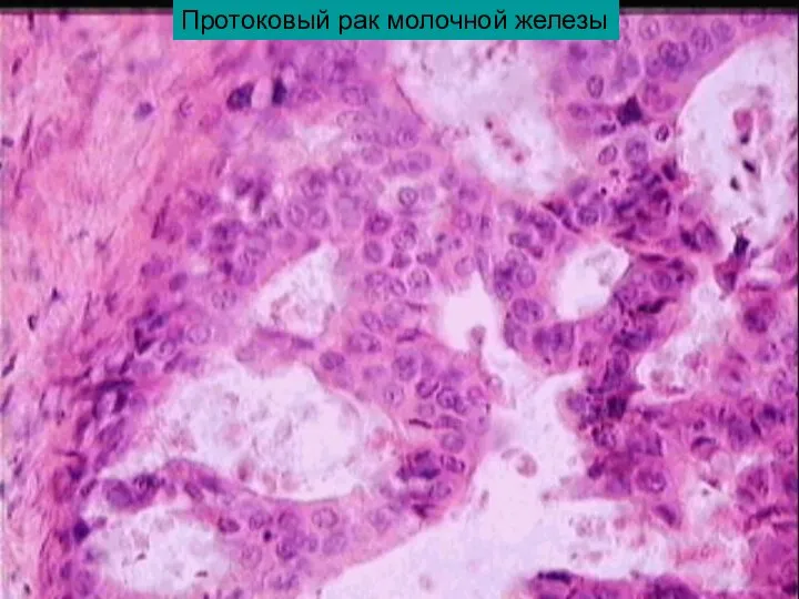 Протоковый рак молочной железы