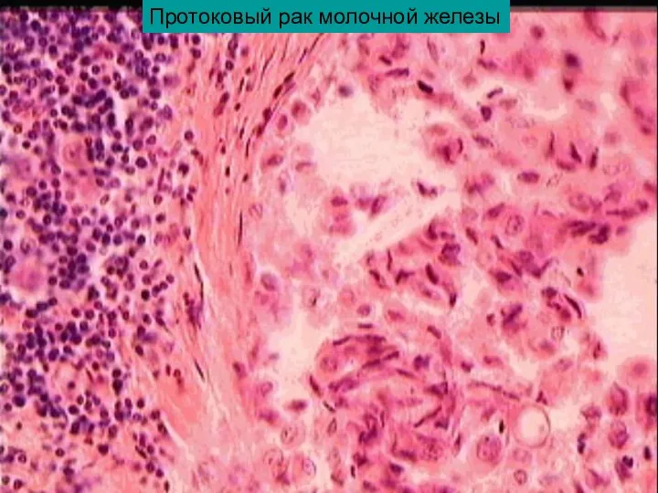 Протоковый рак молочной железы