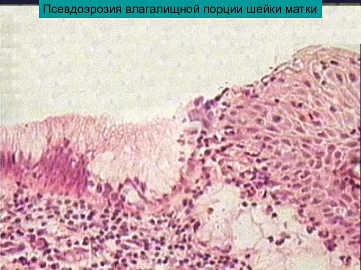 Псевдоэрозия влагалищной порции шейки матки