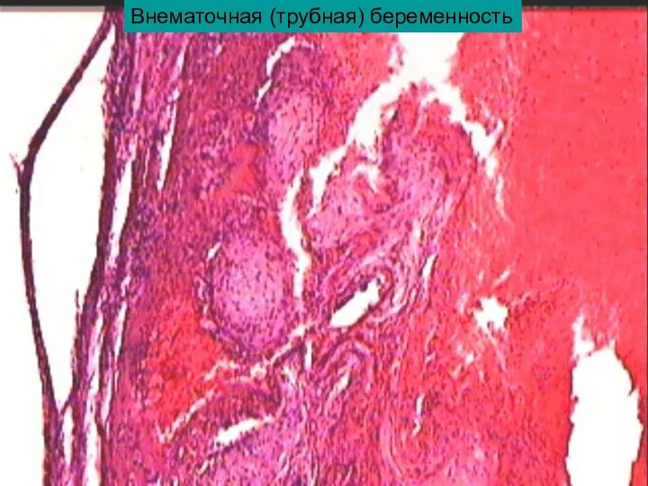 Внематочная (трубная) беременность