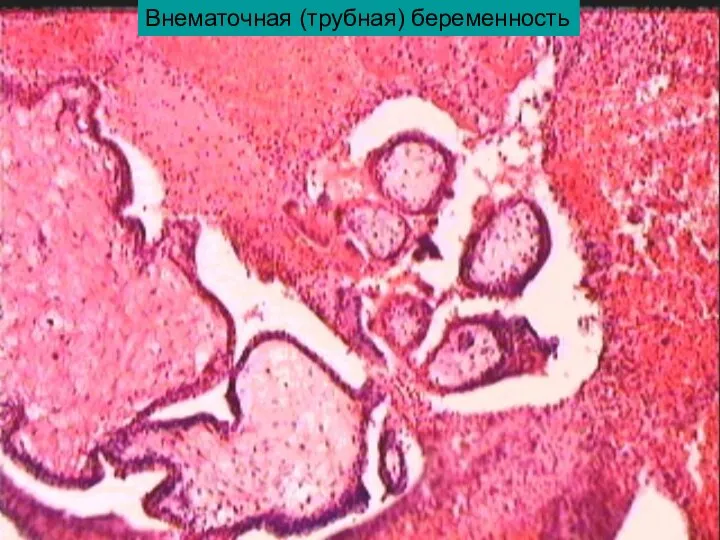 Внематочная (трубная) беременность