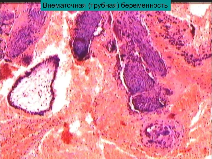 Внематочная (трубная) беременность