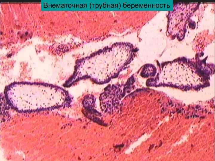 Внематочная (трубная) беременность