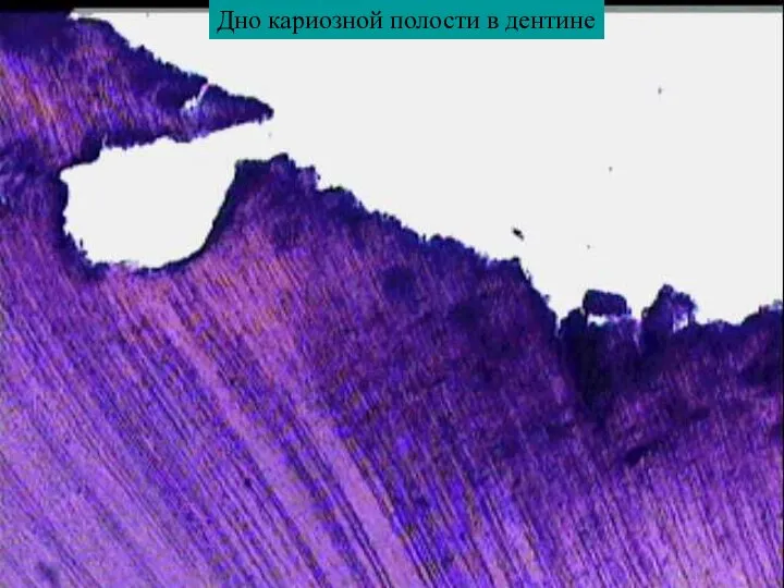 Дно кариозной полости в дентине