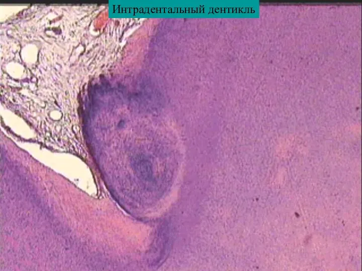 Интрадентальный дентикль