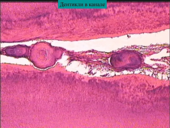 Дентикли в канале