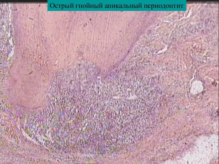 Острый гнойный апикальный периодонтит