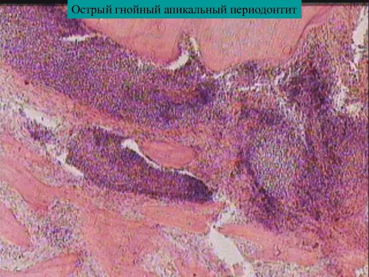 Острый гнойный апикальный периодонтит
