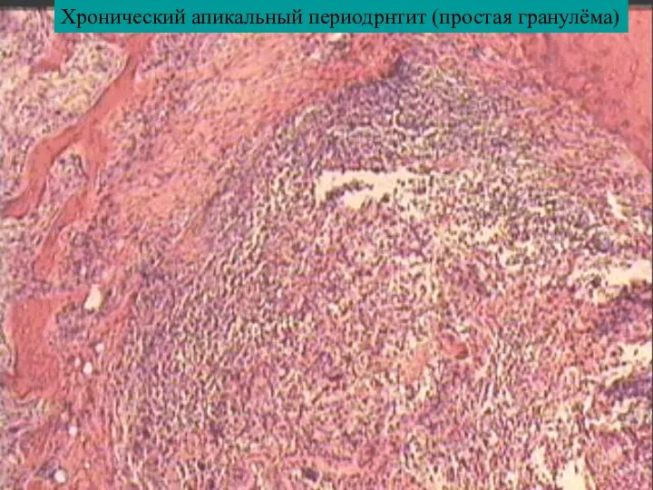 Хронический апикальный периодрнтит (простая гранулёма)
