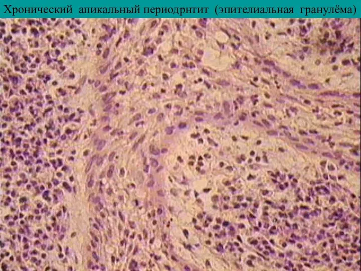 Хронический апикальный периодрнтит (эпителиальная гранулёма)