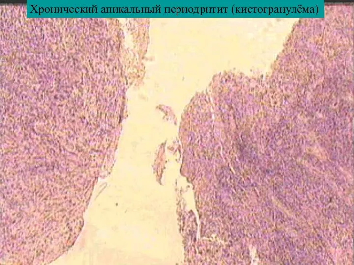 Хронический апикальный периодрнтит (кистогранулёма)
