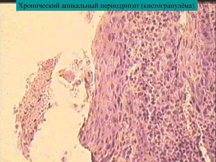 Хронический апикальный периодрнтит (кистогранулёма)