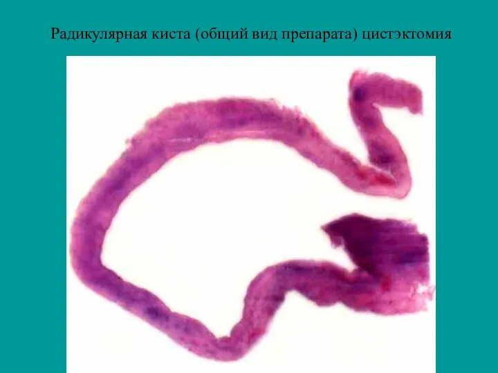 Радикулярная киста (общий вид препарата) цистэктомия