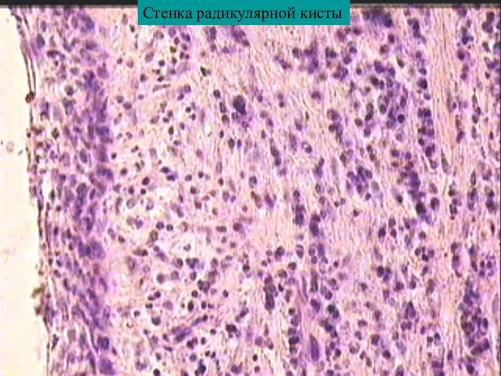 Стенка радикулярной кисты
