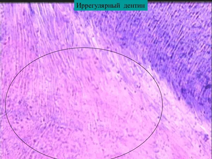 Иррегулярный дентин