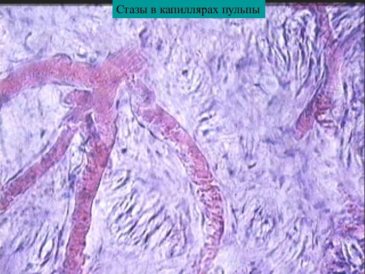 Стазы в капиллярах пульпы