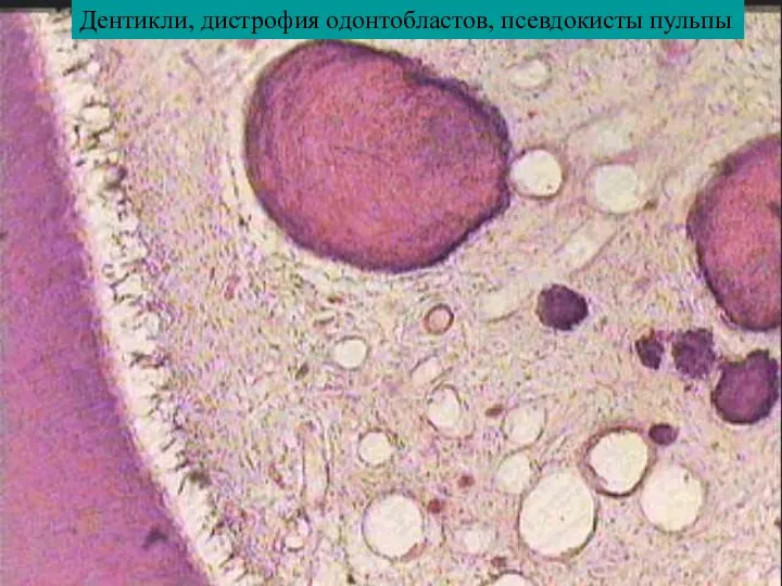 Дентикли, дистрофия одонтобластов, псевдокисты пульпы