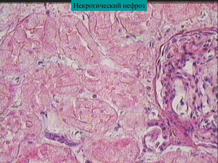 Некротический нефроз