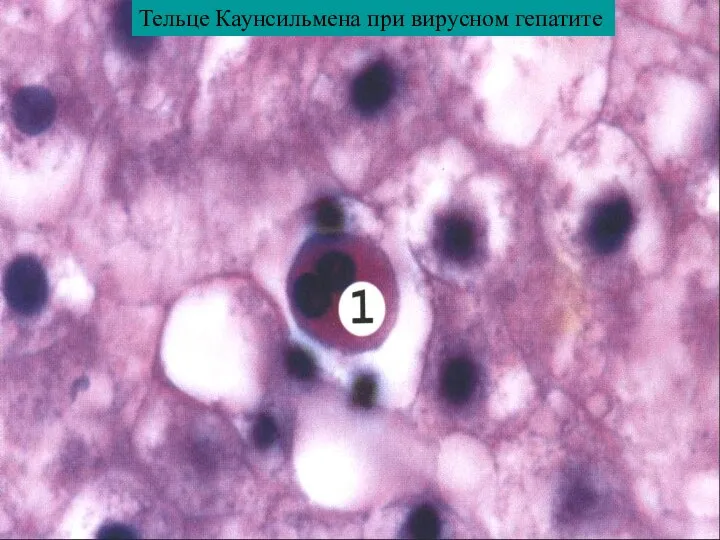 Тельце Каунсильмена при вирусном гепатите