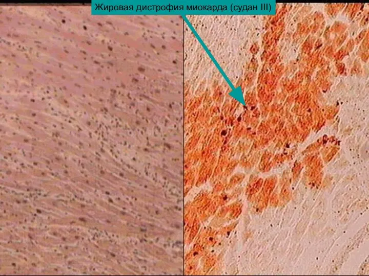 Жировая дистрофия миокарда (судан III)