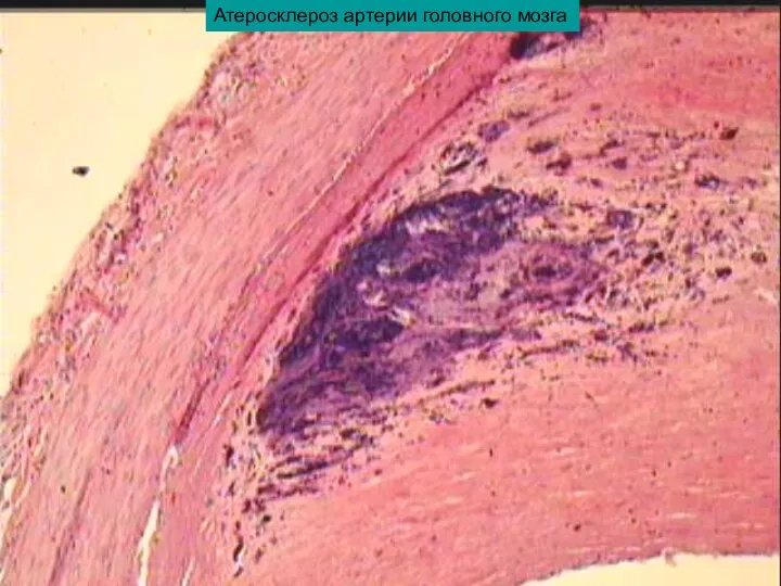 Атеросклероз артерии головного мозга