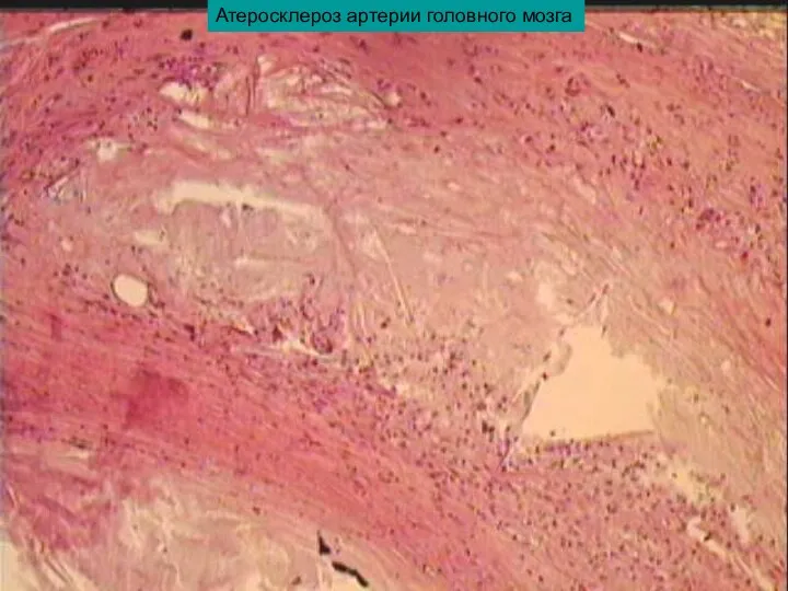 Атеросклероз артерии головного мозга