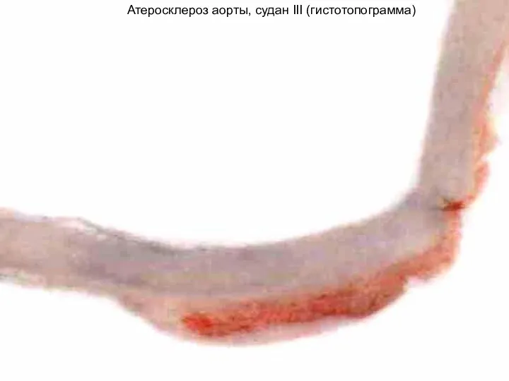 Атеросклероз аорты, судан III (гистотопограмма)