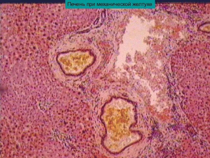 Печень при механической желтухе