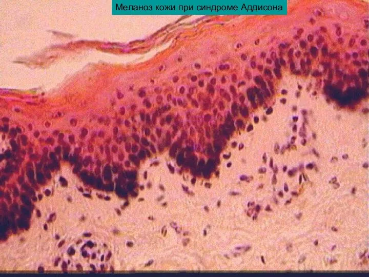 Меланоз кожи при синдроме Аддисона