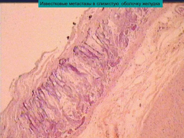 Известковые метастазы в слизистую оболочку желудка