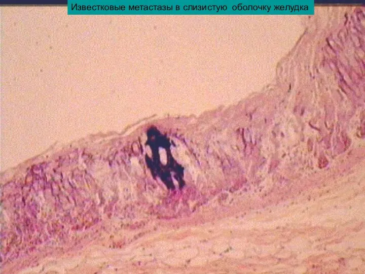 Известковые метастазы в слизистую оболочку желудка